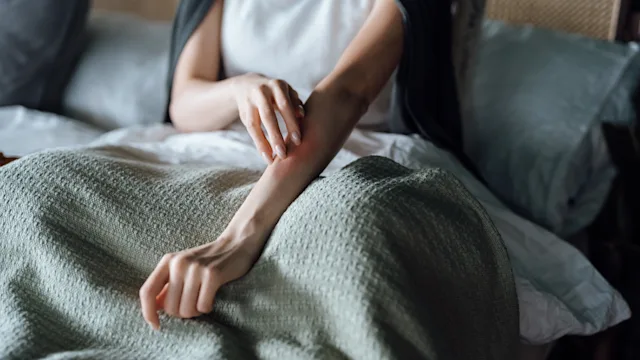Can Stress Cause Rashes? Here’s What Stress Hives Look Like (With Pictures)