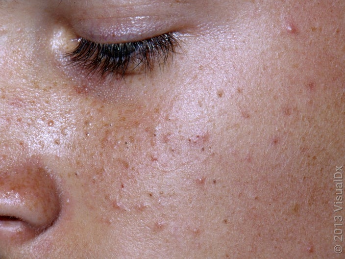 Comedonal acne with many blackheads and whiteheads