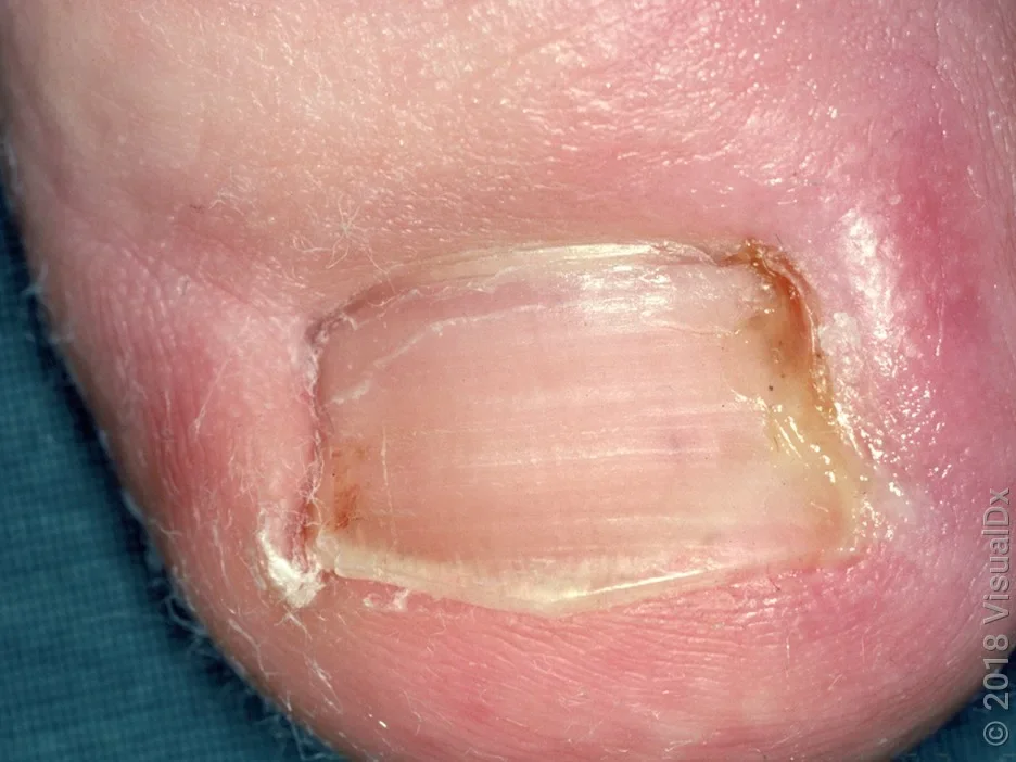Close-up of early-stage, mild ingrown toenail. 