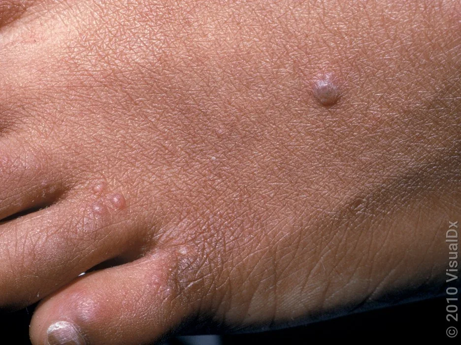 Close-up of shingles bumps and blisters on the foot. 