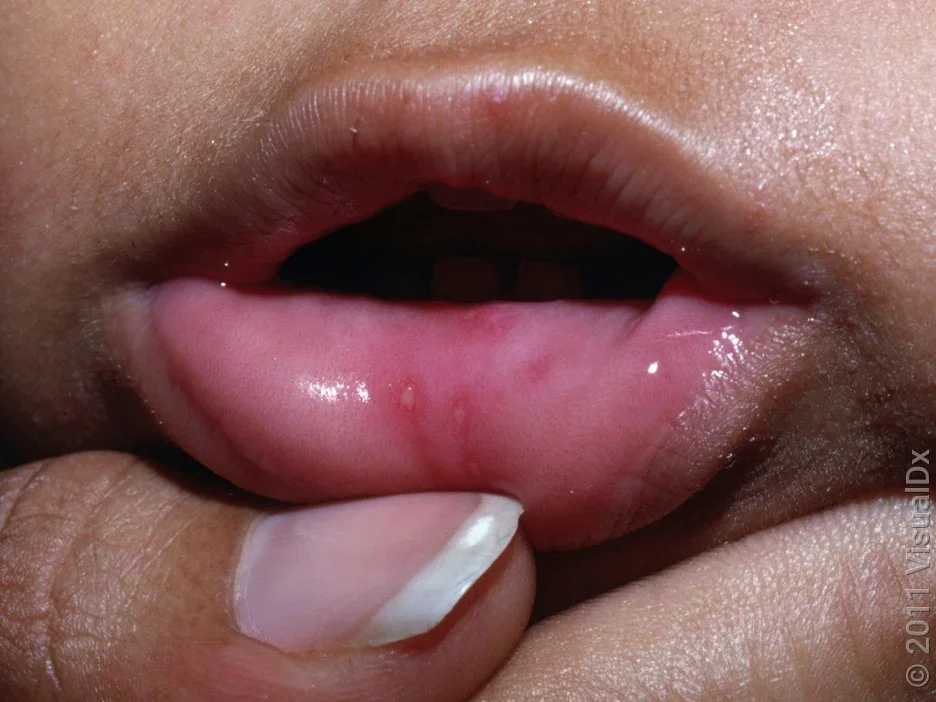 Open sores on the lip from hand, foot, and mouth disease.