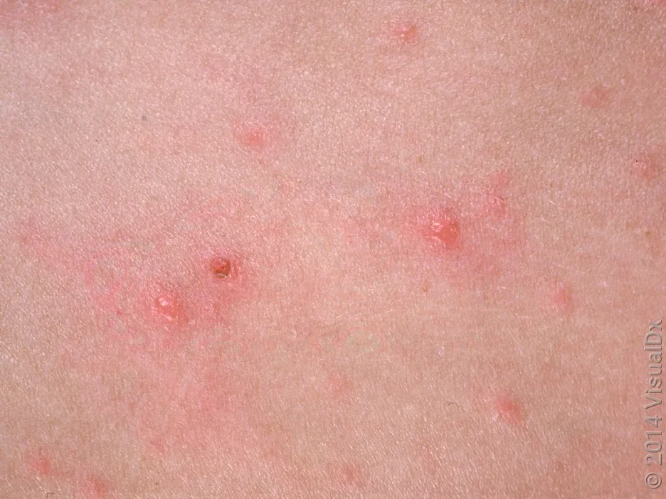Chickenpox scab on fair skin. 