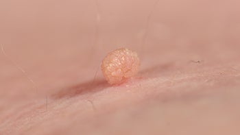 Dermatology: close-up skin tag 968350914