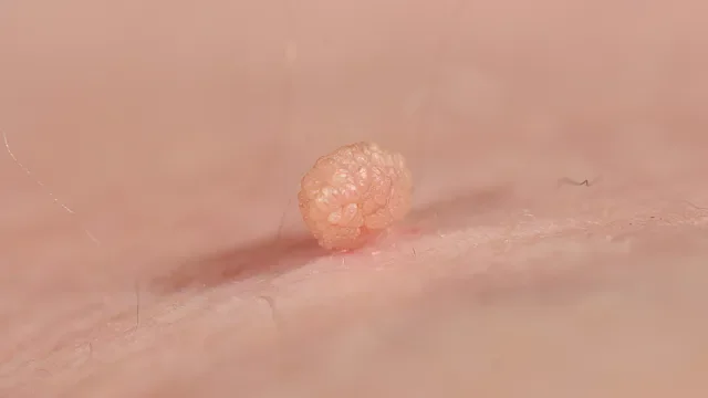 Dermatology: close-up skin tag 968350914