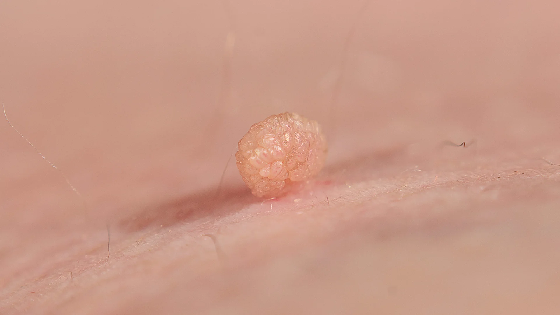 Skin Tags: Causes and Removal (With Pictures) - GoodRx