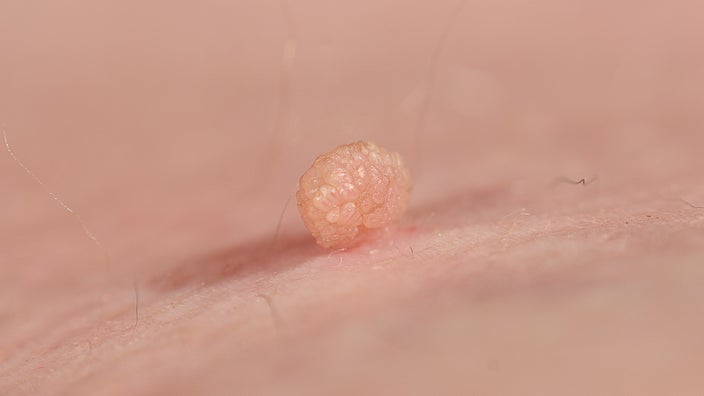 Close-up of a skin tag.