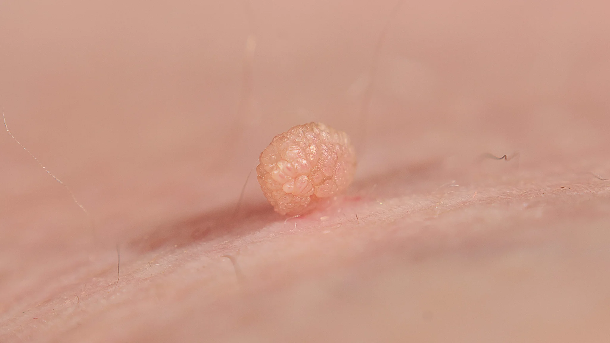What Causes Skin Tags: Surprising Factors You Need to Know