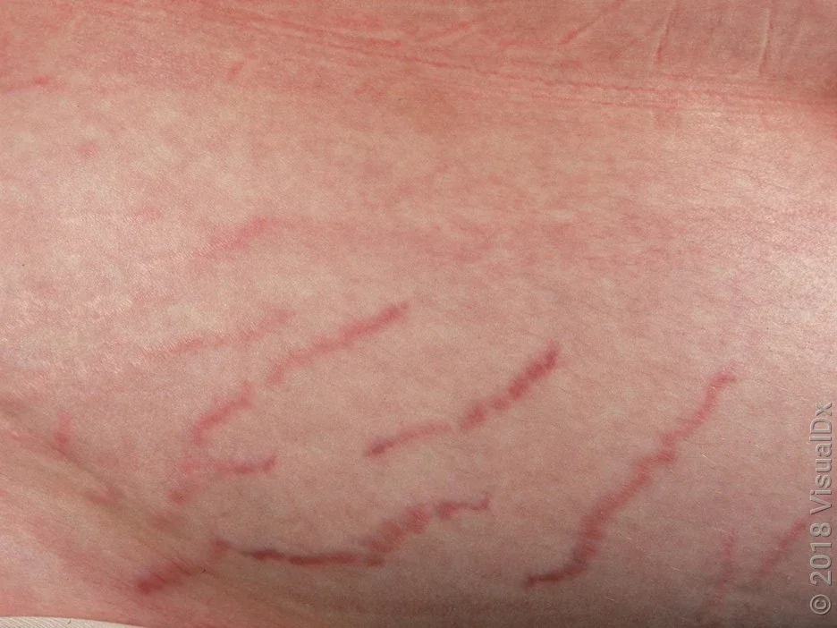 Close-up look of early stretch marks.