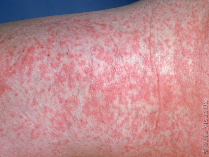 A close-up of a rubella (also called German measles) rash. 