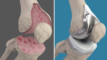 knee-replacement-surgery.jpg