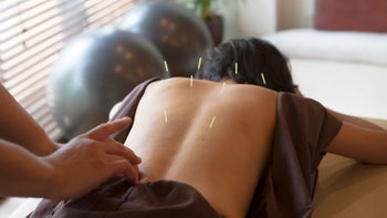 FSA HSA: woman acupuncture session 543683646