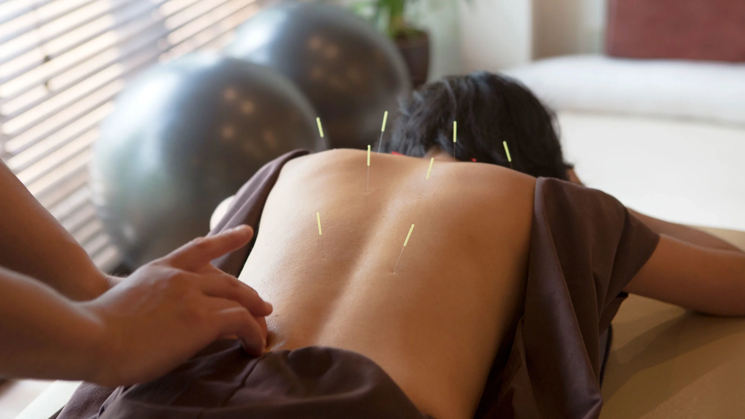 A woman receives acupuncture treatment.