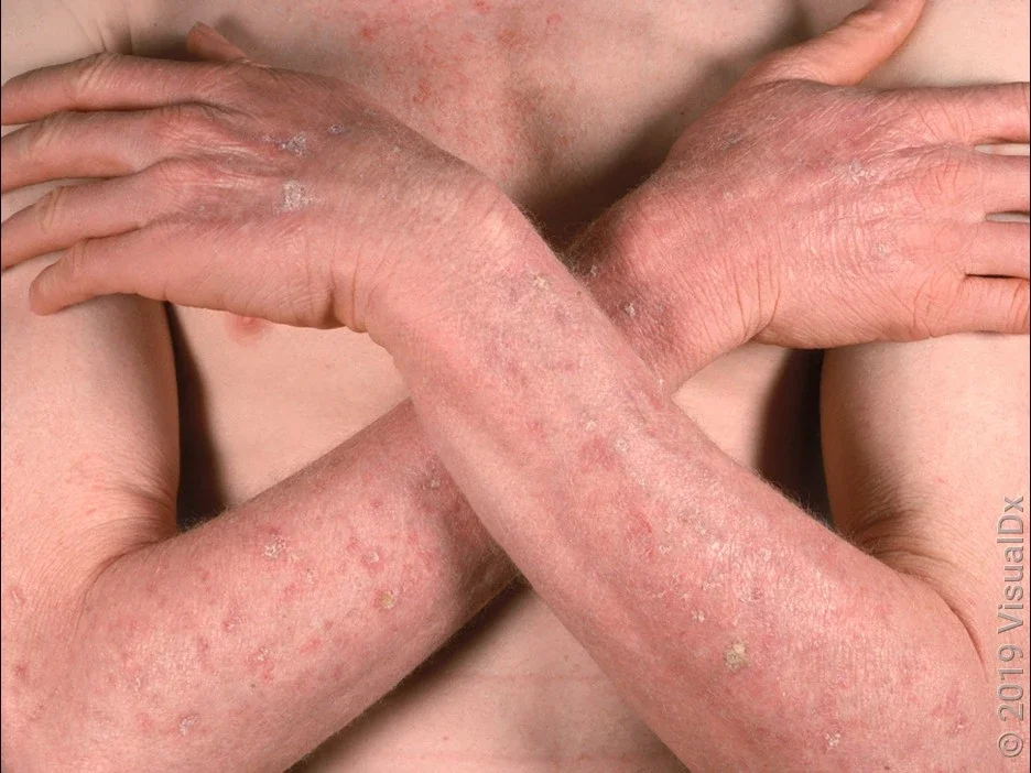 Several actinic keratoses on the backs of the hands and arms.