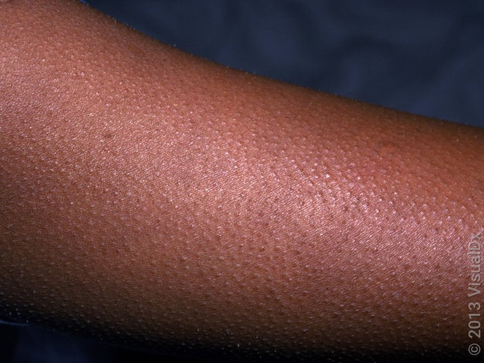 Keratosis pilaris on the arm in darker skin. 