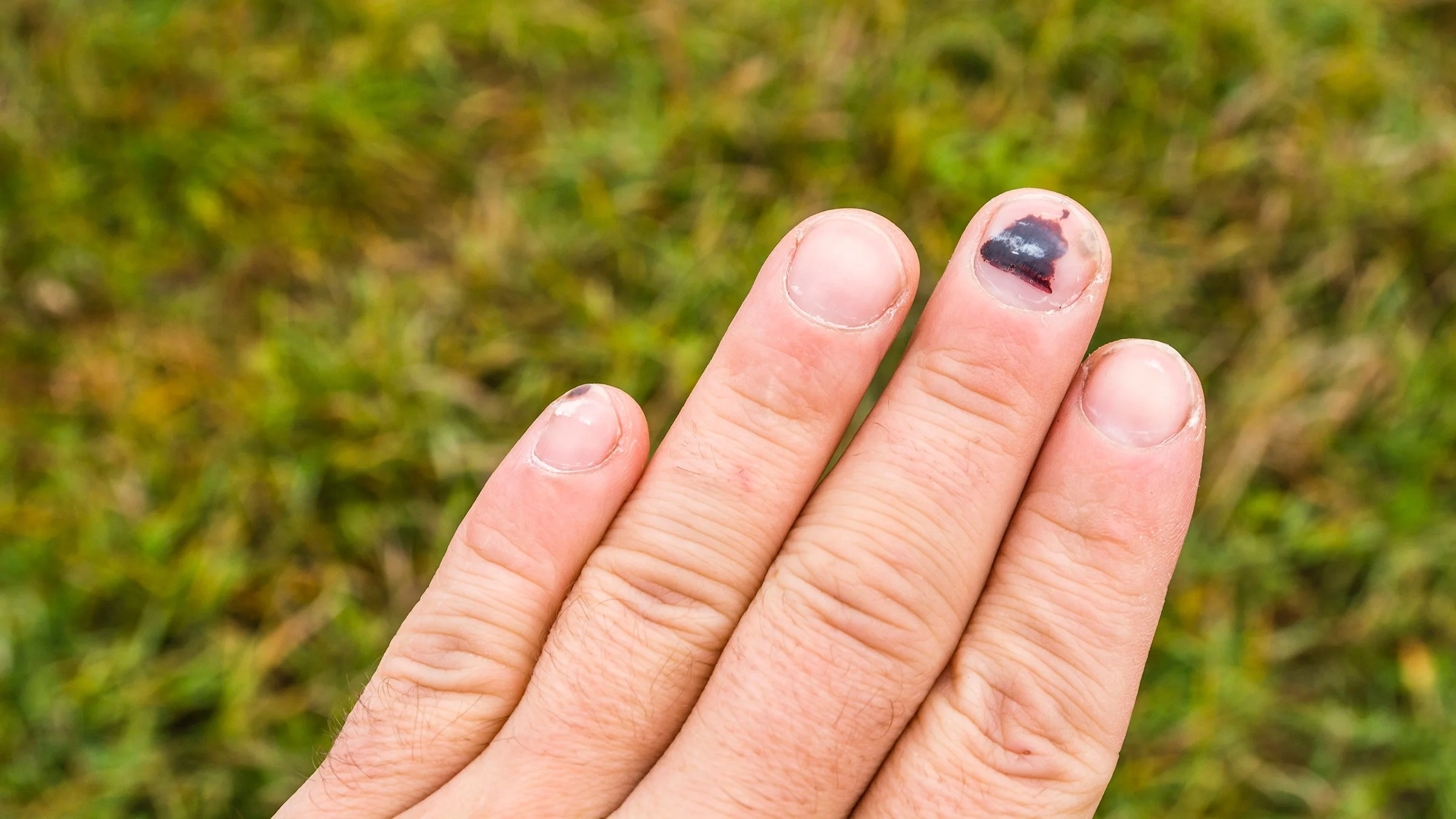 A person's four fingers on their left hand with a grassy background. There is a subungual hematoma on the middle finger. There are red blotches and a black spot on the fingernail.