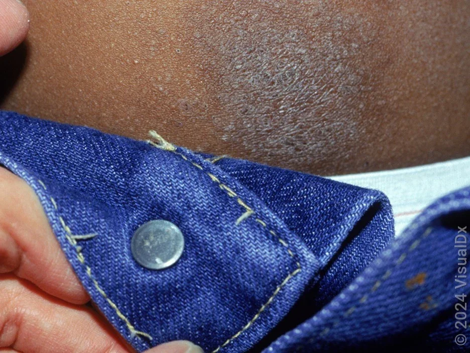 Close-up of nickel allergy rash from a button. 