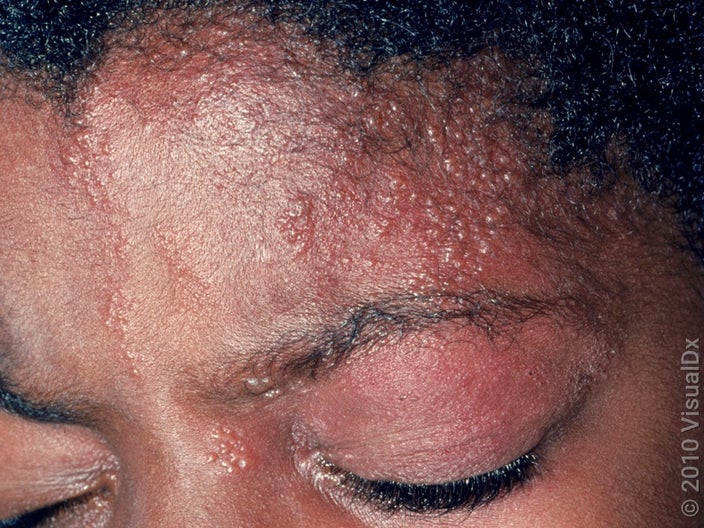 Close-up of shingles on the face. 