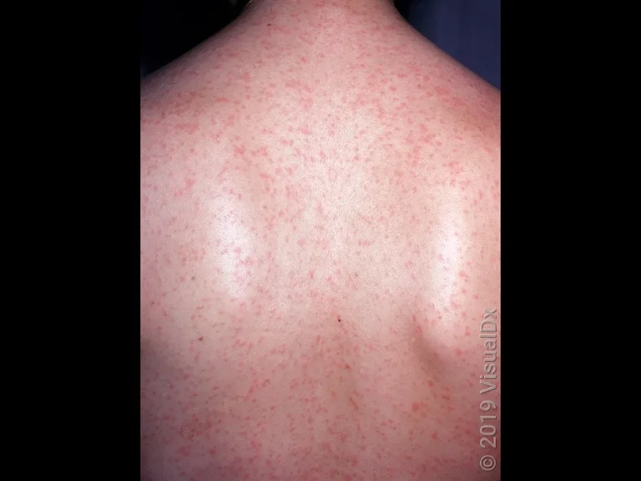 A close-up look at a rubella rash on the back.