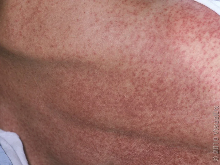 A close-up look at an antibiotic rash on the back. 