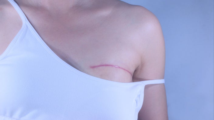 Cropped image of person lowering a strap to reveal a masectomy scar.