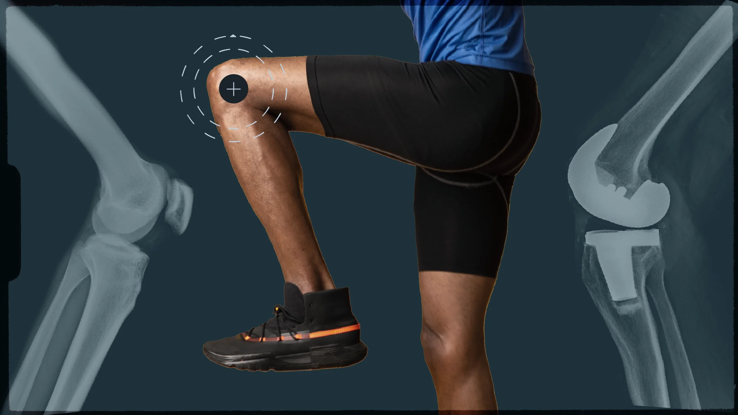 A custom graphic shows an athletic figure’s lower body with a target pinpoint on the knee joint, surrounded by X-ray images of a knee before and after surgery.
