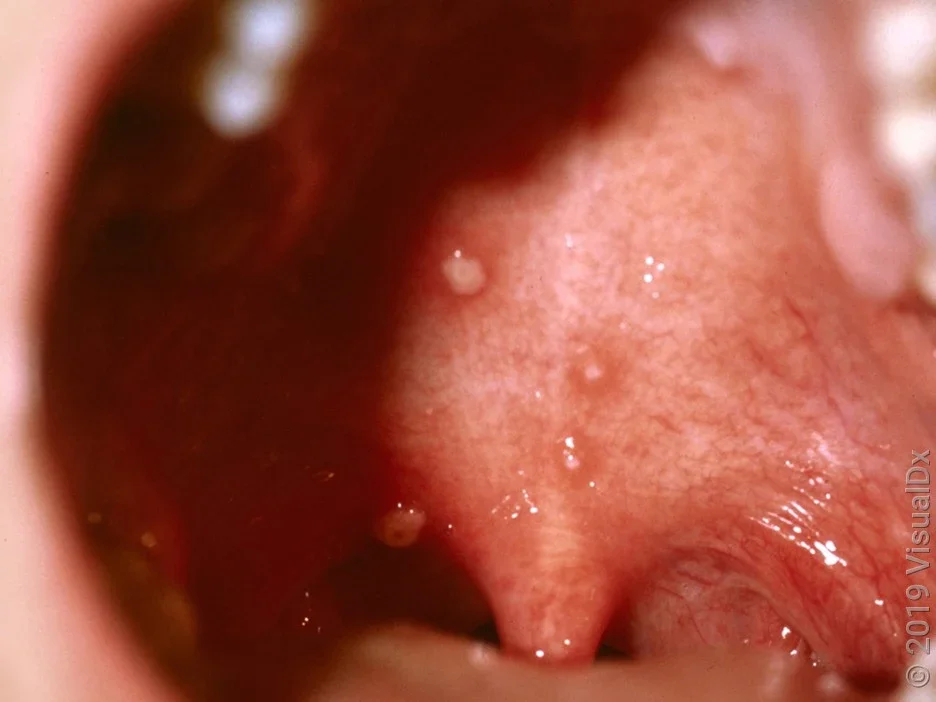 Chickenpox blisters inside the mouth. 