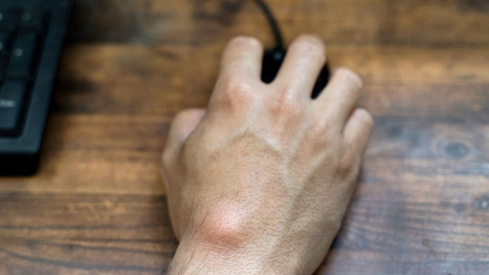 A close-up of a ganglion cyst on an adult’s hand.