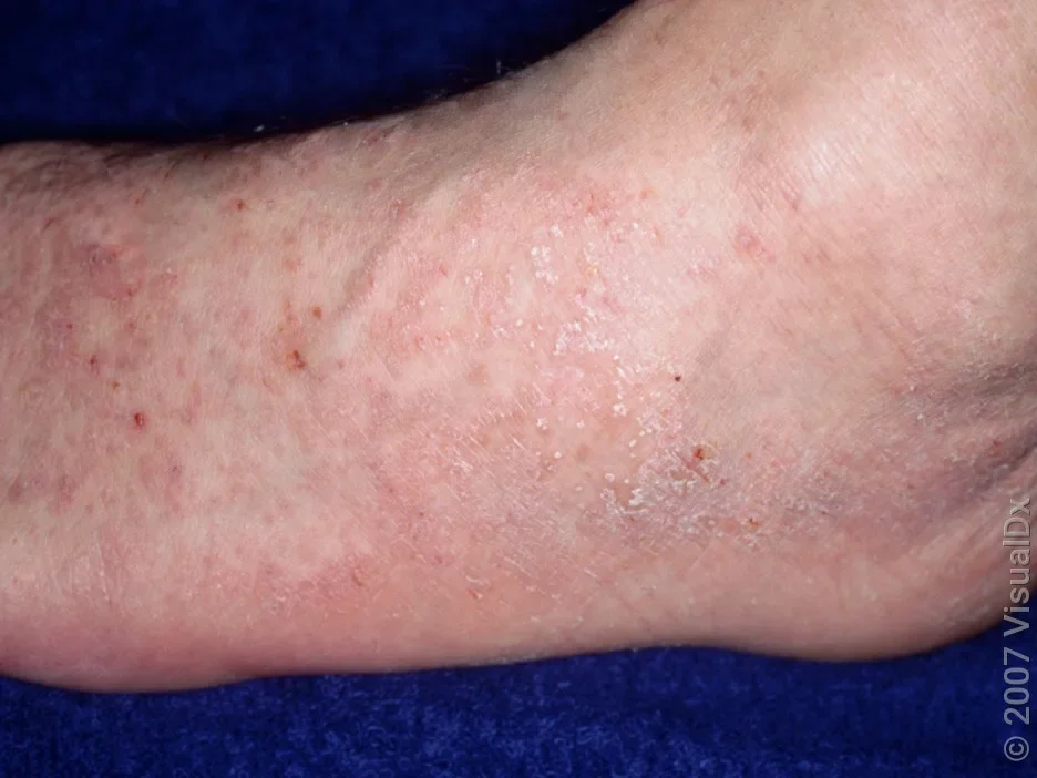 A foot with pink skin bumps and patches with some scales and scratches.