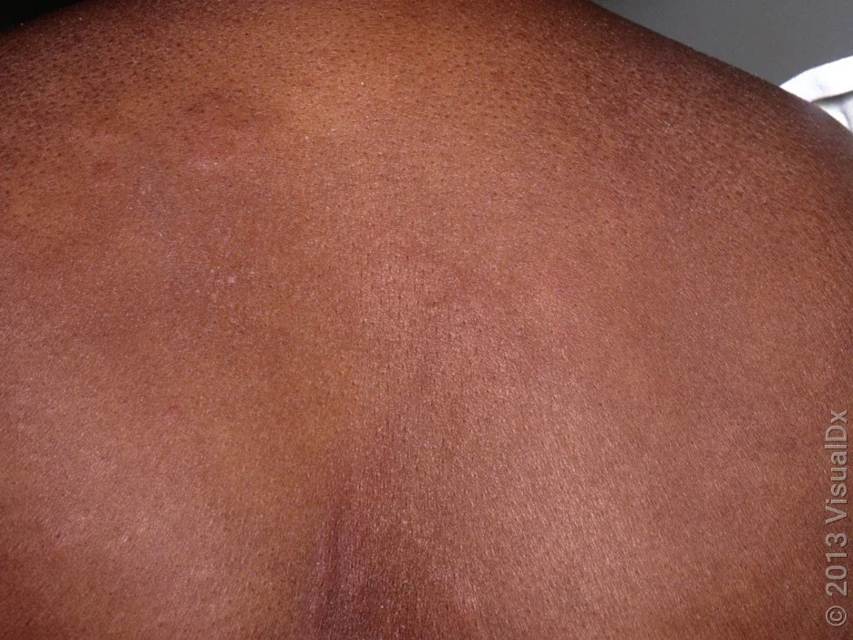 Close-up of hives on Black skin. 