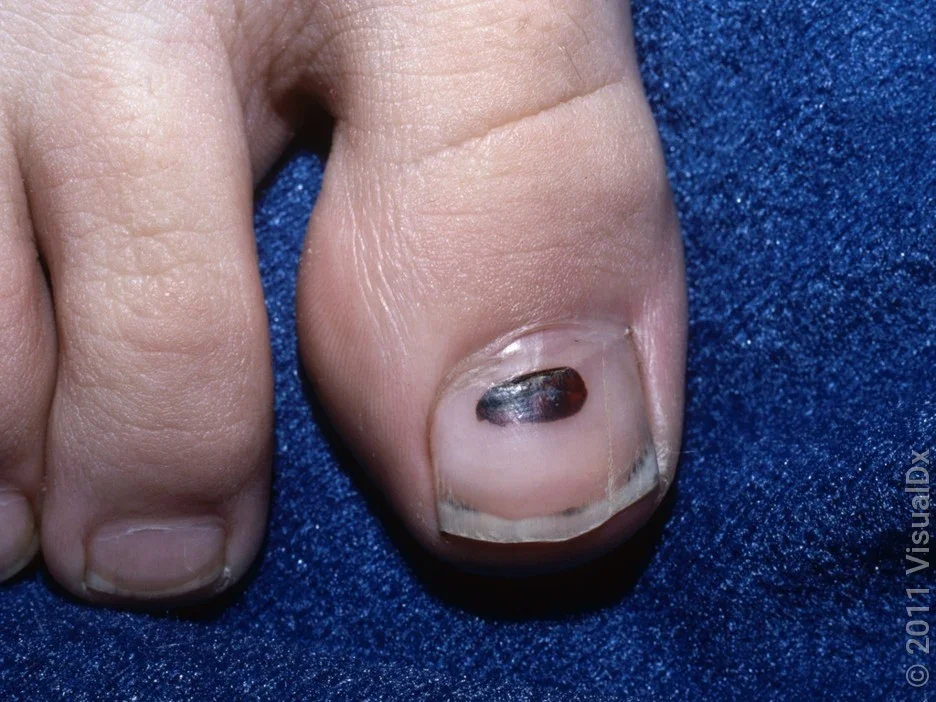 Close-up of a small subungual hematoma on the toenail.