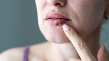 Cold sore: Contagious: closeup woman cold sore 1327942112