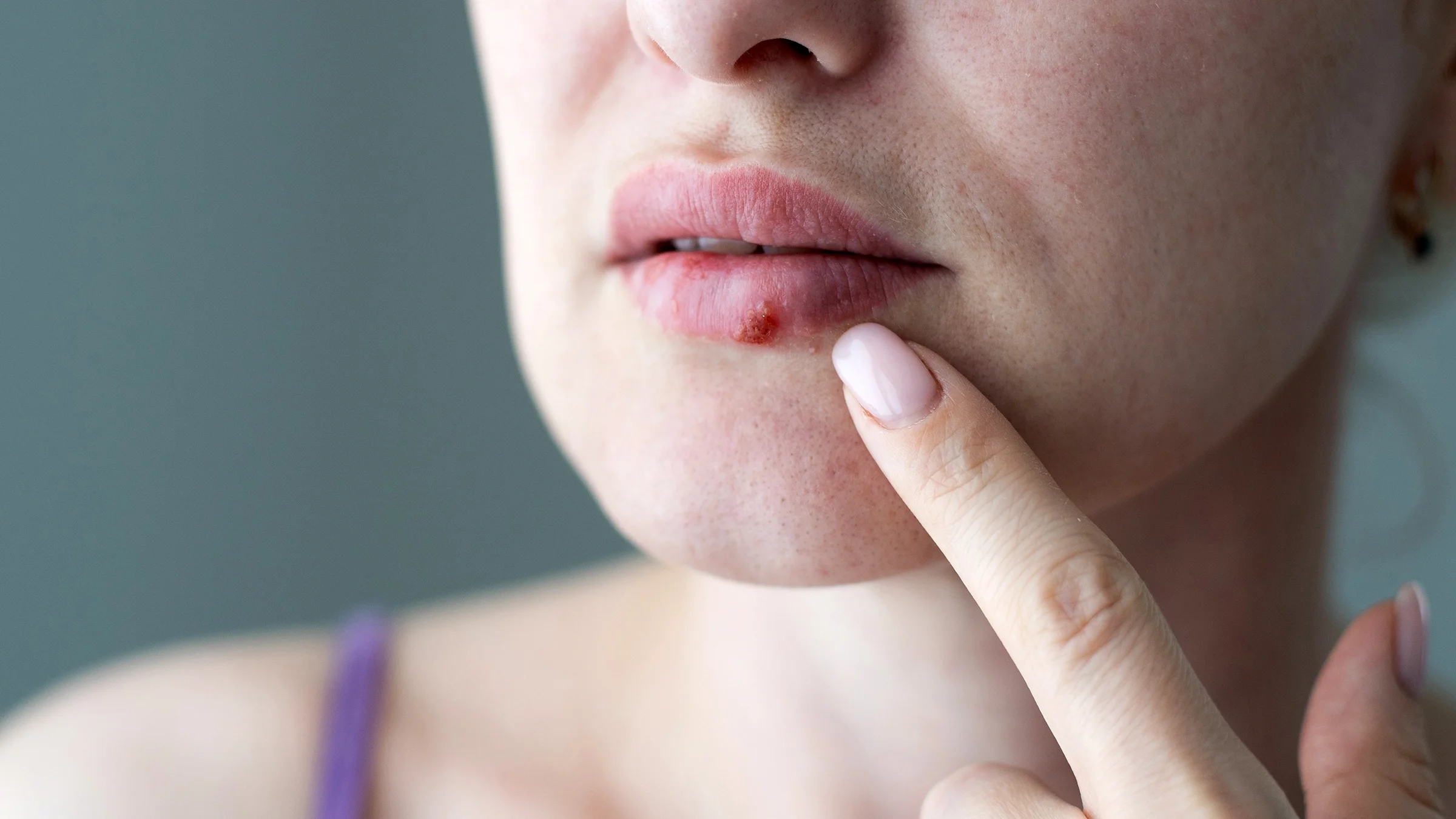 A close-up image shows a woman with a cold sore on her lip.