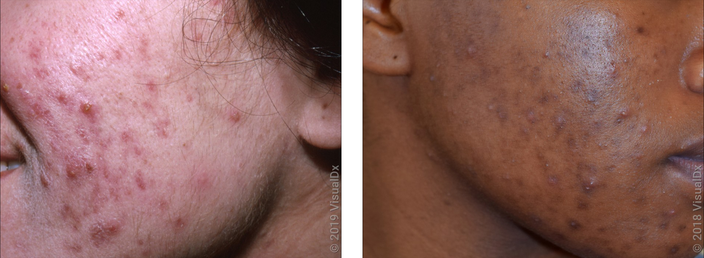 Left: Close-up of cheek with red acne marks mixed with acne. Right: Close-up of cheek with brown acne marks mixed with acne.
