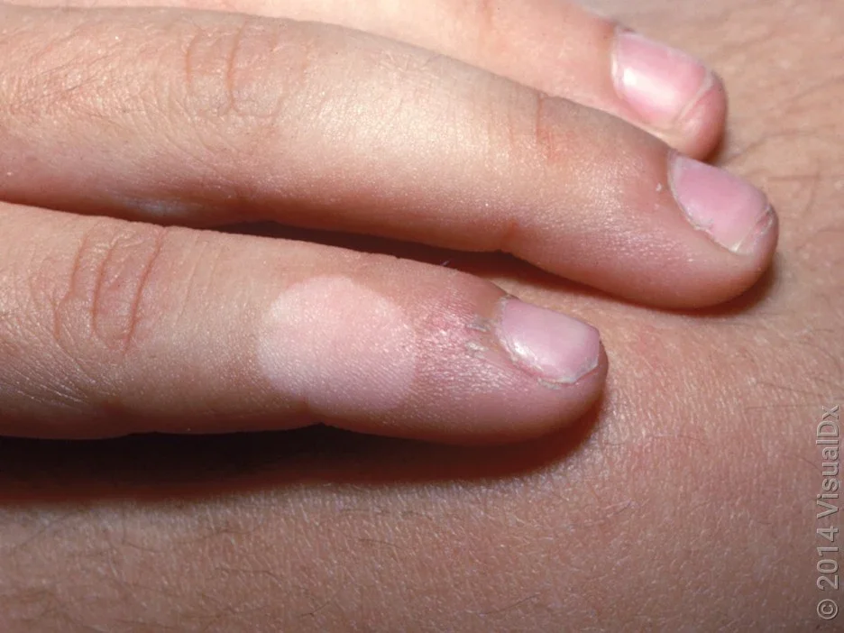 Close-up of the finger with vitiligo.