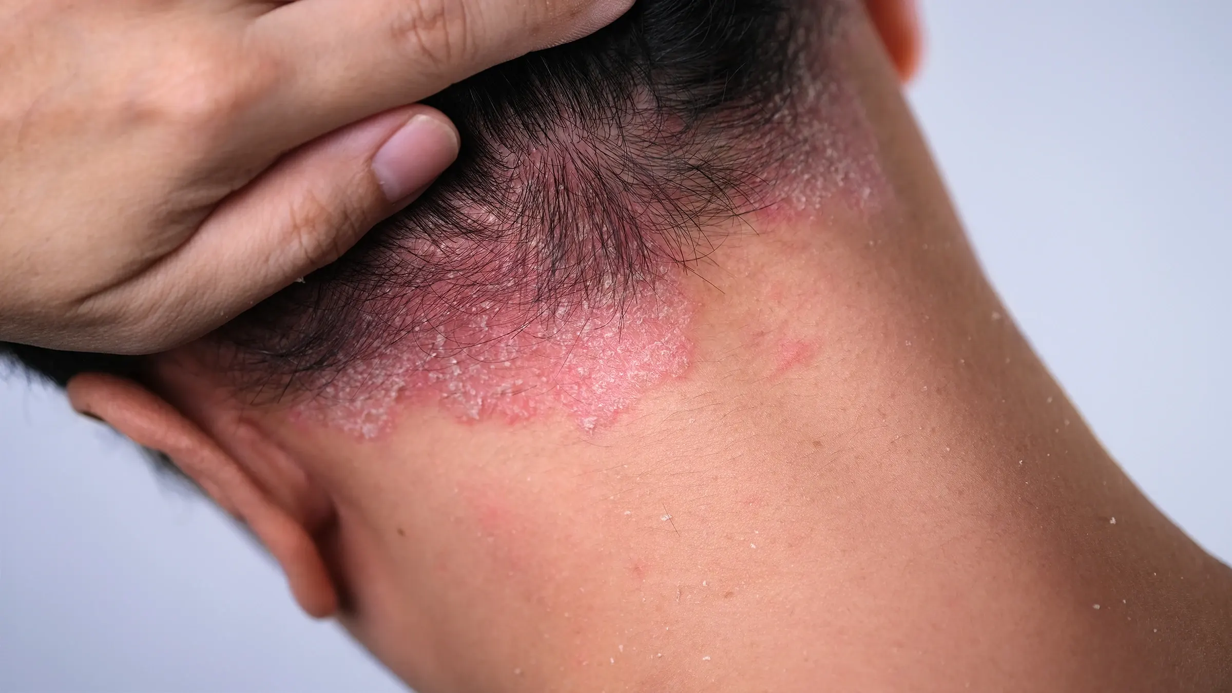 Psoriasis: closeup psoriasis on nape 1604751312