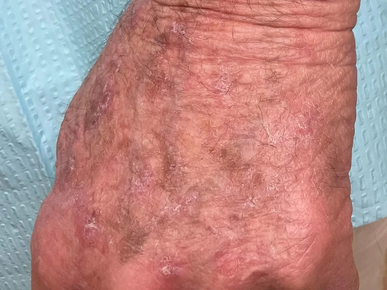 Close-up of the back of the hand with many actinic keratoses. 