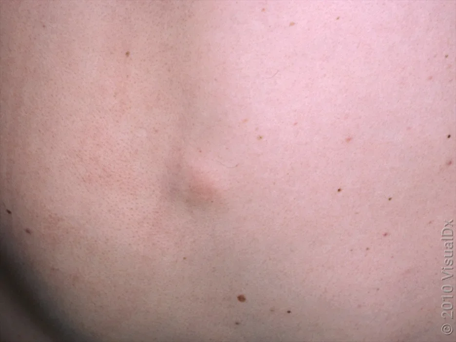 Close-up of a back lipoma. 