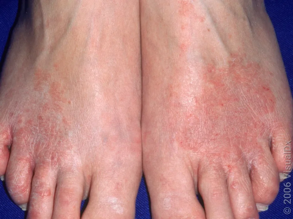 Close-up of ringworm on the feet (athlete’s foot).
