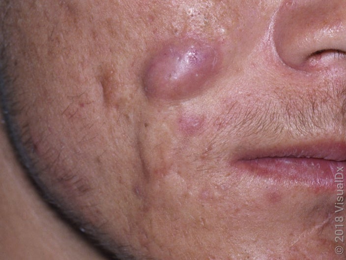 A large pink cyst in cystic acne.