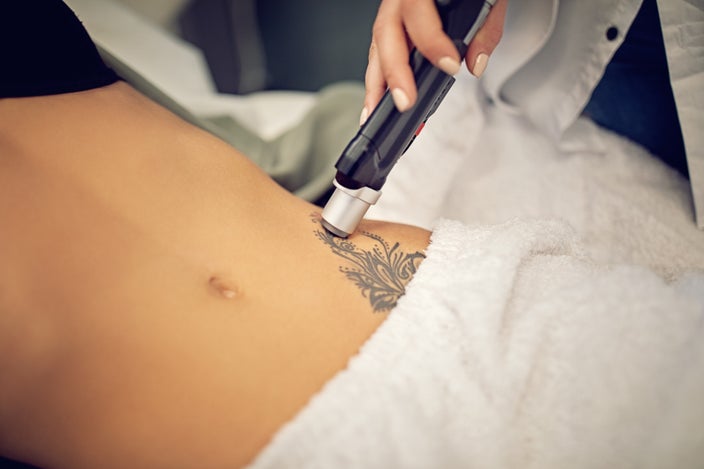 Close-up of a woman's abdomen with a large tattoo at the beginning of tattoo removal with a laser.