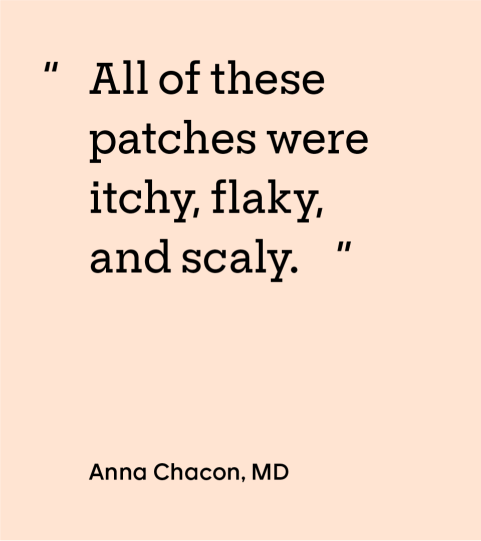 “All of these patches were itchy, flaky, and scaly.” — Anna Chacon, MD