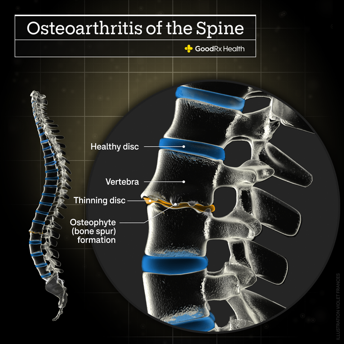 A 3D illustration of a spine with osteoarthritis including healthy disc, vertebra, thinning disc, and osteophyte (bone spur) formation. 