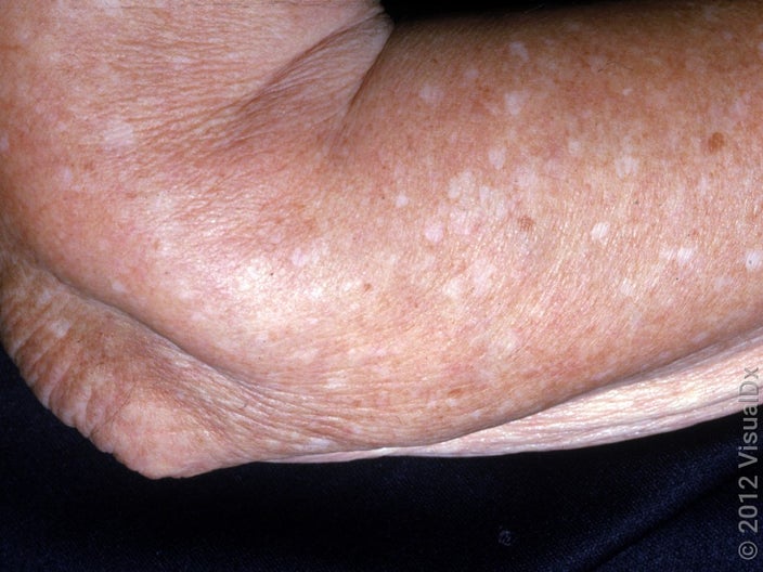 Close-up of an arm with idiopathic guttate hypomelanosis. 