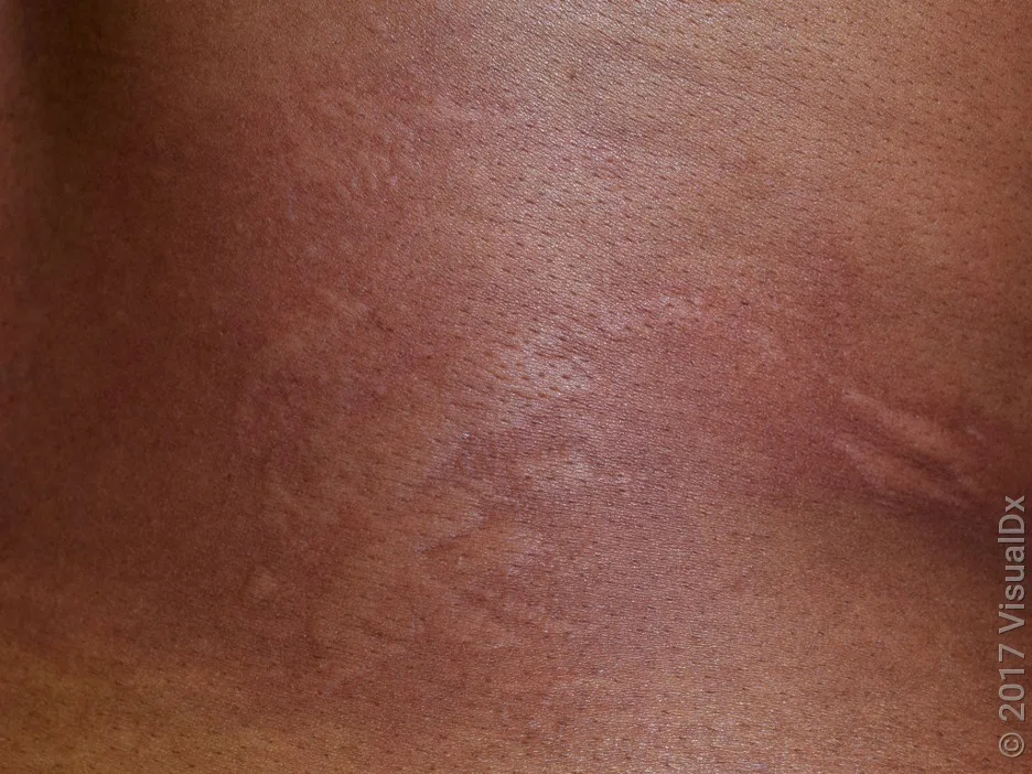 Hives in darker skin.