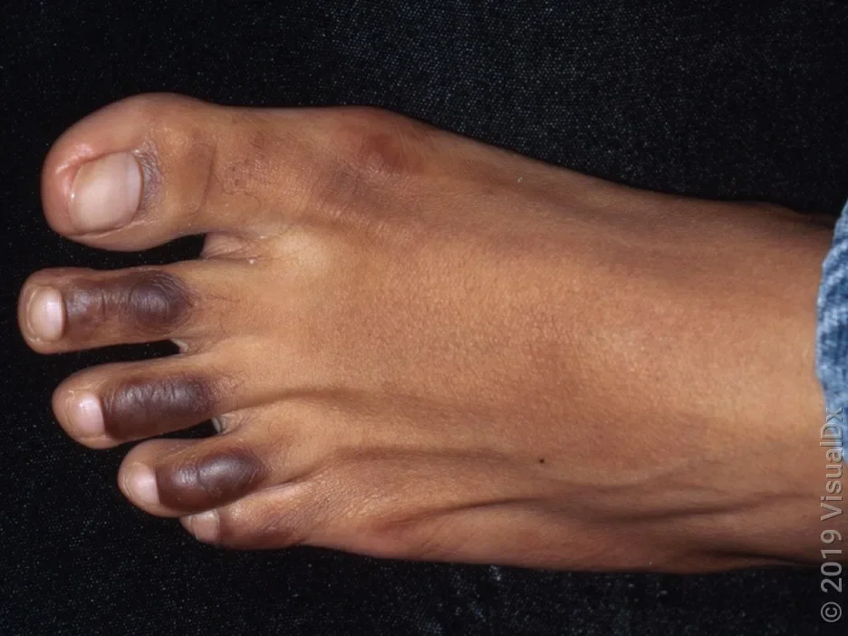 Calluses over the tops of the toes. Calluses may look like patches of darkened skin in people with darker skin tones.