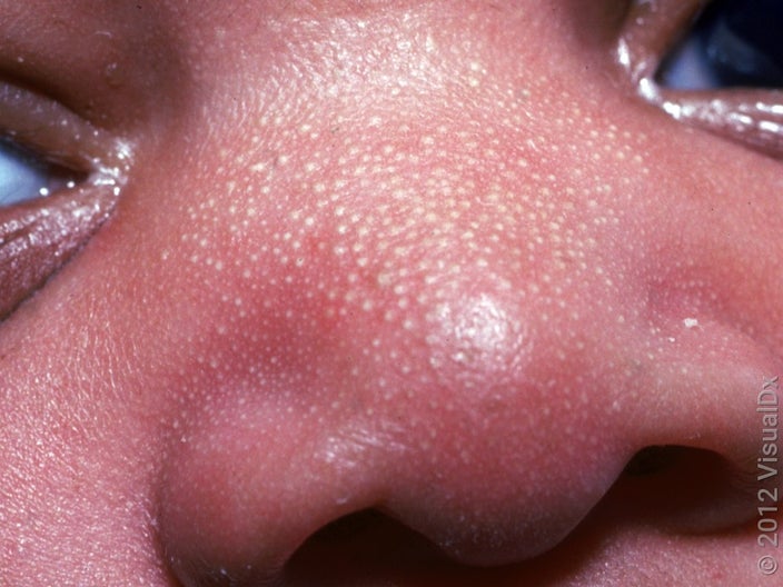 Many tiny, white bumps on an infant’s nose with sebaceous hyperplasia.