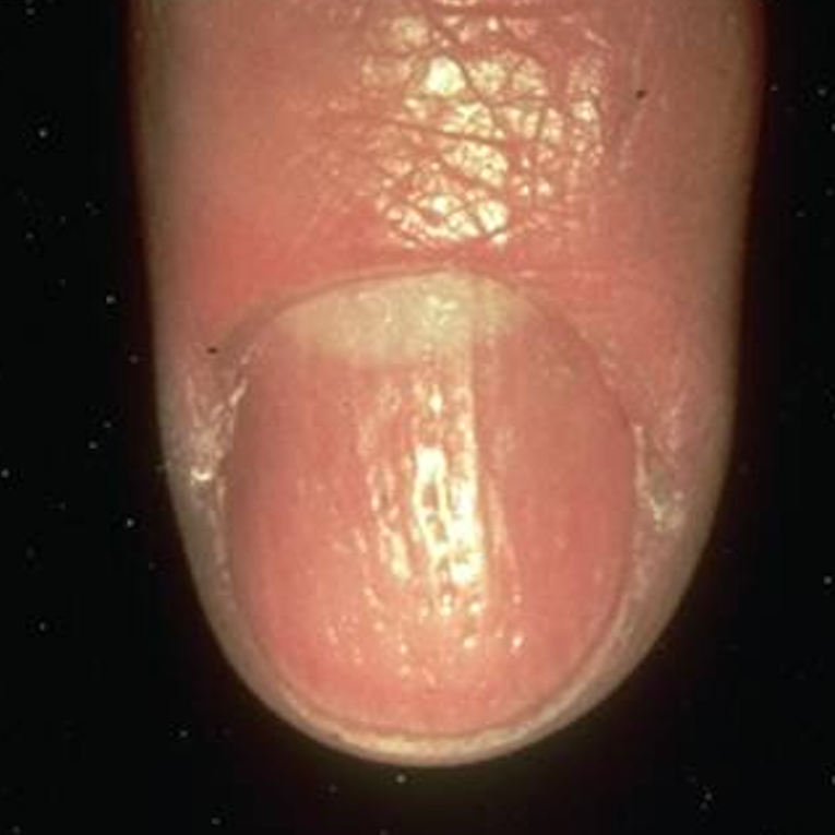 Psoriatic Arthritis Nail Symptoms: 6 Common Signs - GoodRx Psoriatic Arthritis Nail Symptoms: 6 Common Signs - GoodRx
