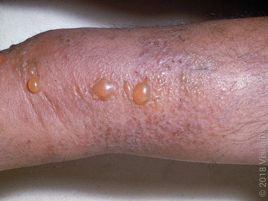 Close-up of allergic skin rash. 