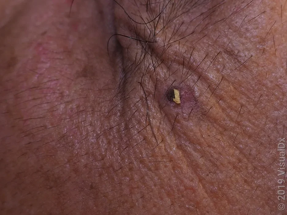 Close-up of an actinic keratosis on darker skin tone.