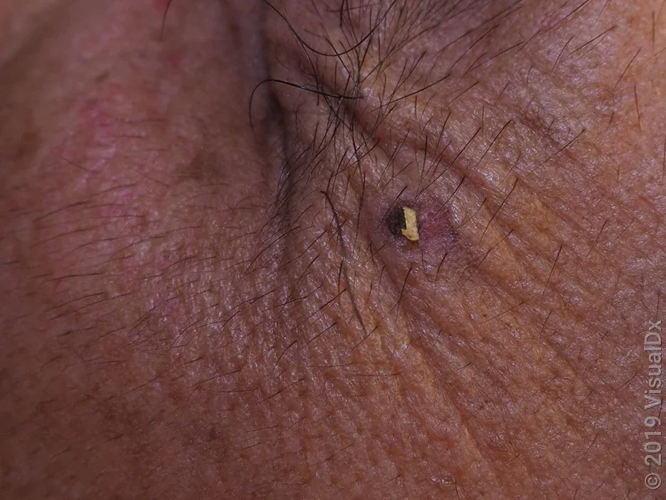 Close-up of an actinic keratosis on darker skin tone.